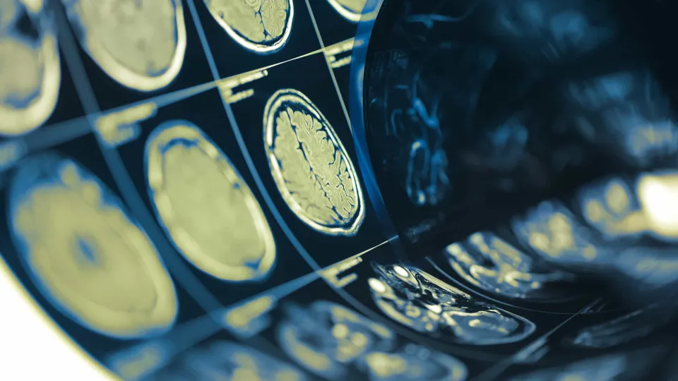 Association calls for national plan for rehabilitation of stroke survivors