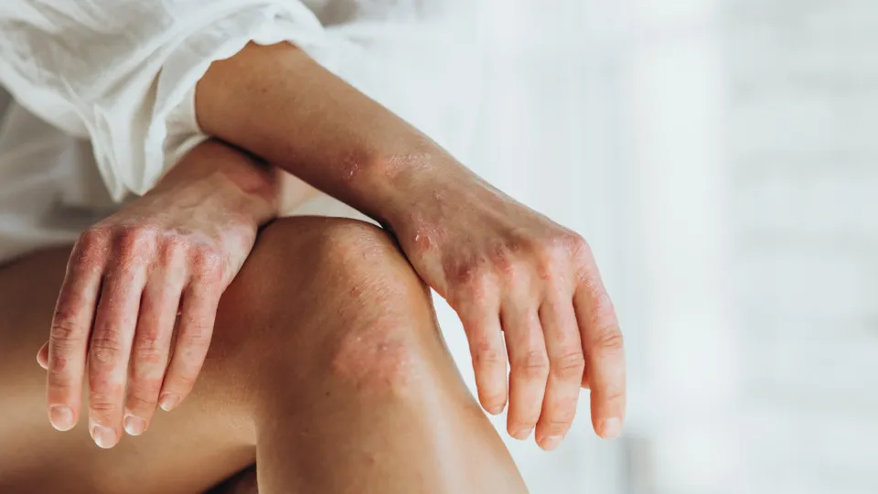 Psoríase. Má higiene é a causa? Só afeta a pele? Dermatologista esclarece